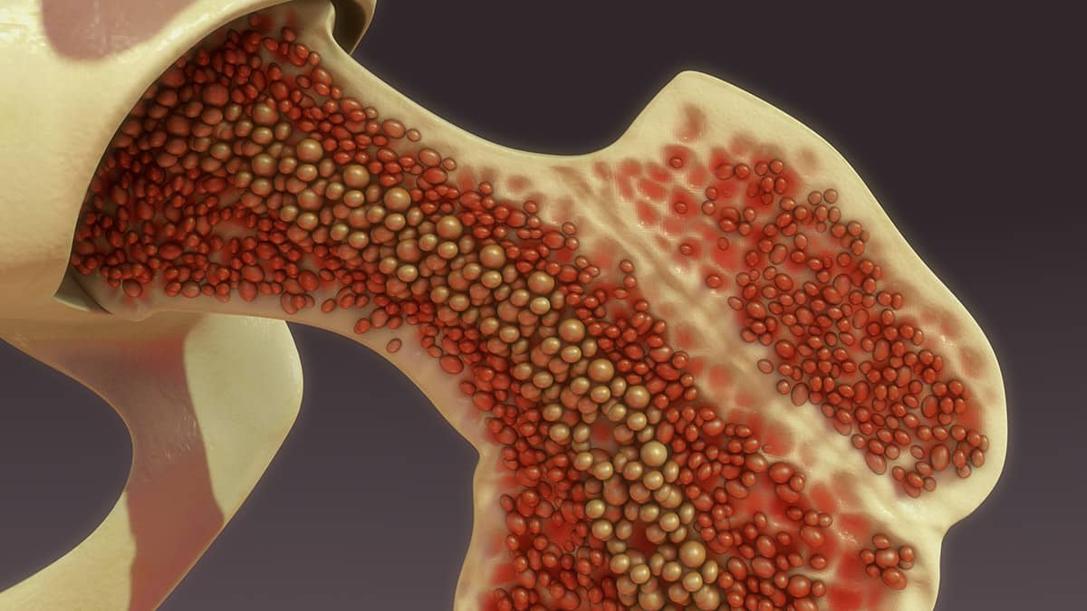 Bone Marrow Aspirate Concentrate